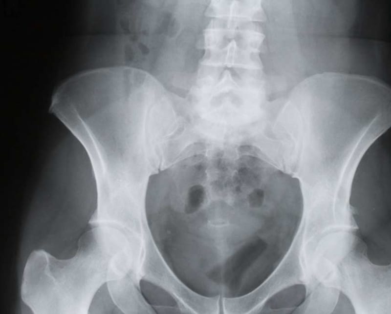 Sacroiliac Joint Sprain