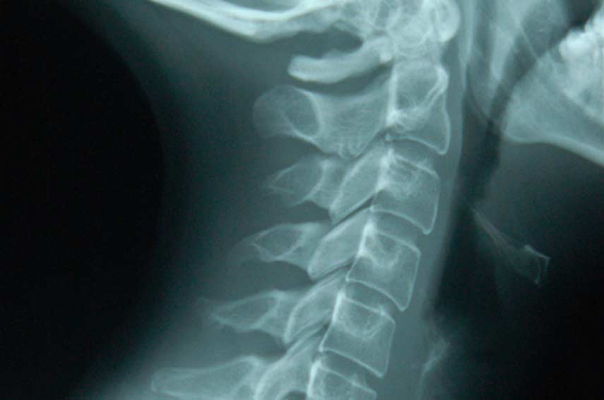 spinal-x-rays-universal-care-personal-injury